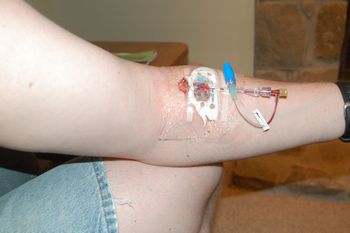Image of the "PICC" line in left arm